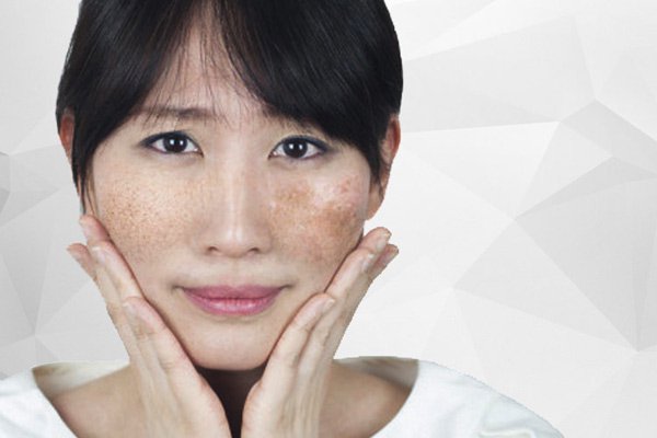 nám da mặt vùng má là gì? nguyên nhân nám da