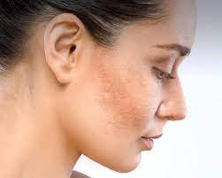 nguyên nhân nám da mặt vùng má