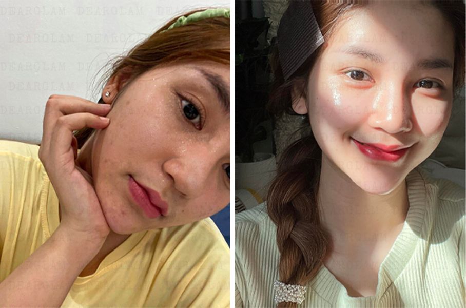 REVIEW 7 KEM DƯỠNG TRẮNG MỜ NÁM TỐT NHẤT 2024 Group 10 20240507113854 Ixs3k